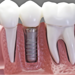 Why Avoid Dairy After a Dental Implant? Key Reasons Explained